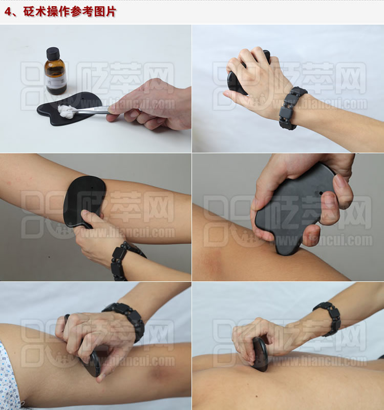 砭術(shù)操作參考圖片